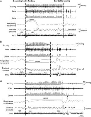 Effects of Nasal Continuous Positive Airway Pressure and High-Flow Nasal Cannula on Sucking, Swallowing, and Breathing during Bottle-Feeding in Lambs